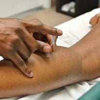 The insertion of acupuncture needles is usually painless or causes minimal discomfort. You may feel a slight tingling sensation or a dull ache at the insertion site, but this typically subsides...