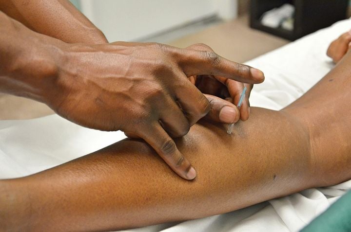 The insertion of acupuncture needles is usually painless or causes minimal discomfort. You may feel a slight tingling sensation or a dull ache at the insertion site, but this typically subsides...