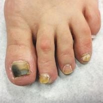 A Day in the Life of a Nail Expert: Diagnosing and Treating Nail Fungus